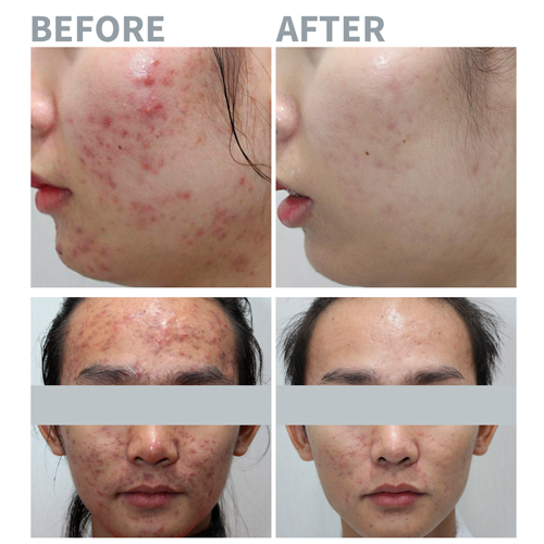 MEDIMINE Phyto A.CICA Ampoule / Authentic / International Shipping from Korea picture 4