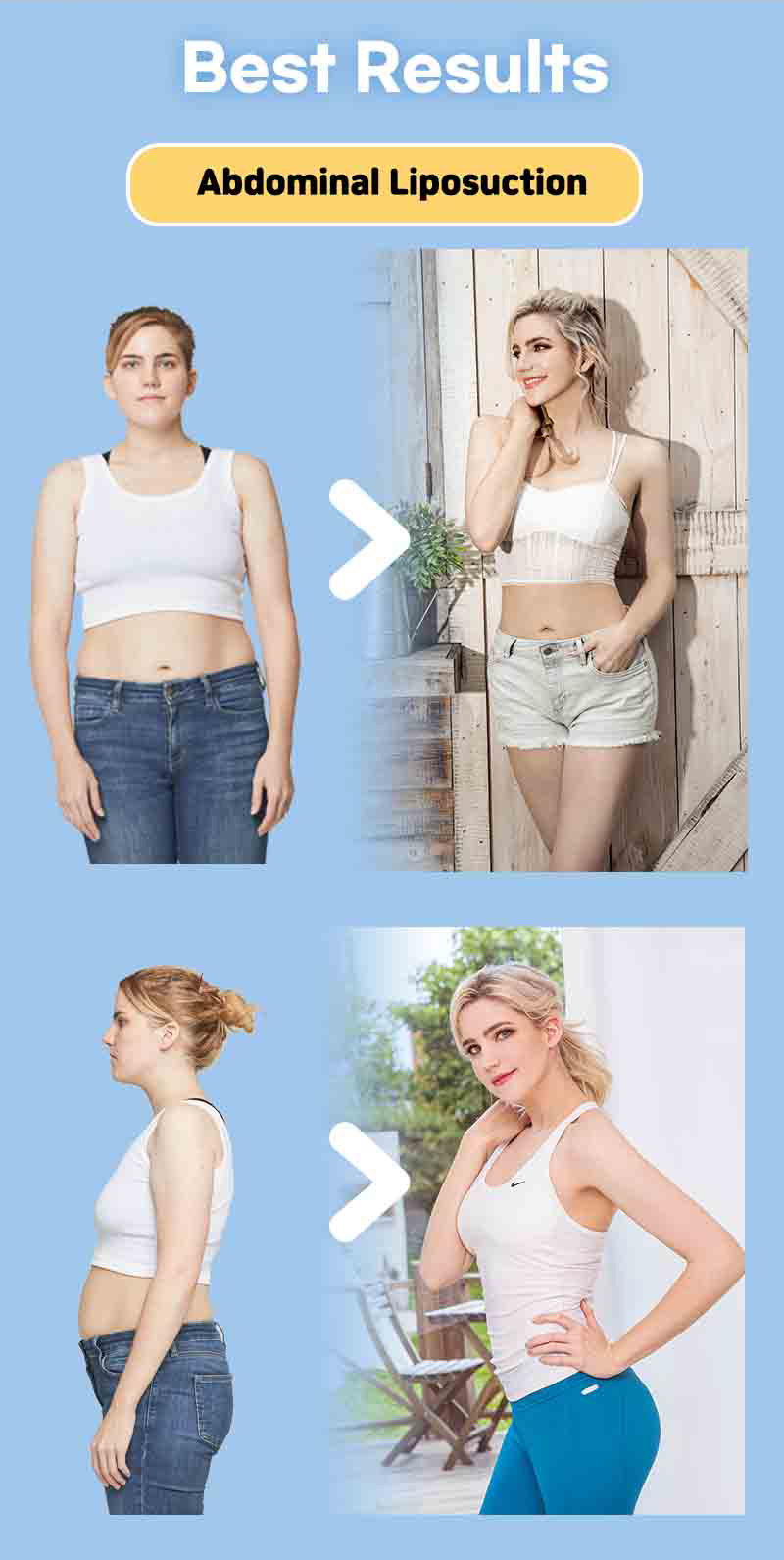 Before and after pictures for abdomen liposuction and under eye bag removal of MINE Plastic Surgery in Korea