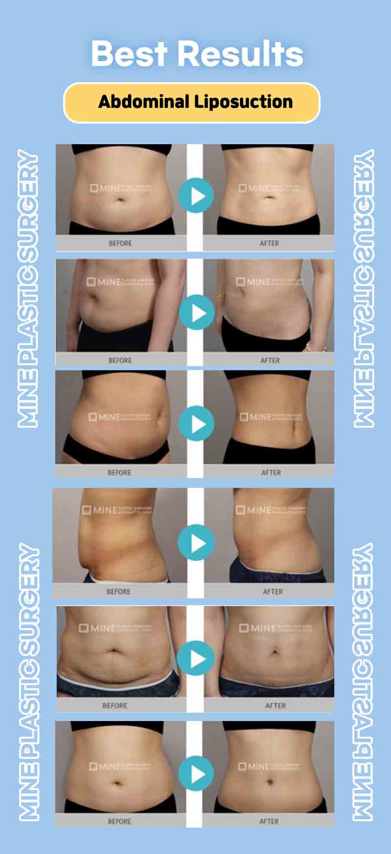 Before and after pictures for abdomen liposuction and under eye bag removal of MINE Plastic Surgery in Korea