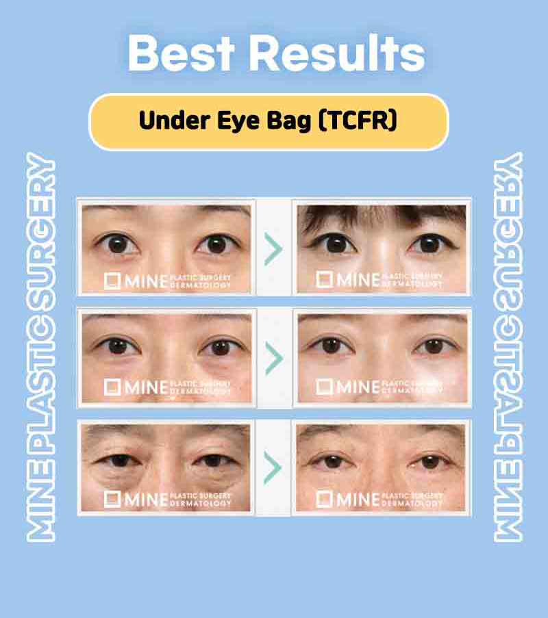 Before and after pictures for abdomen liposuction and under eye bag removal of MINE Plastic Surgery in Korea