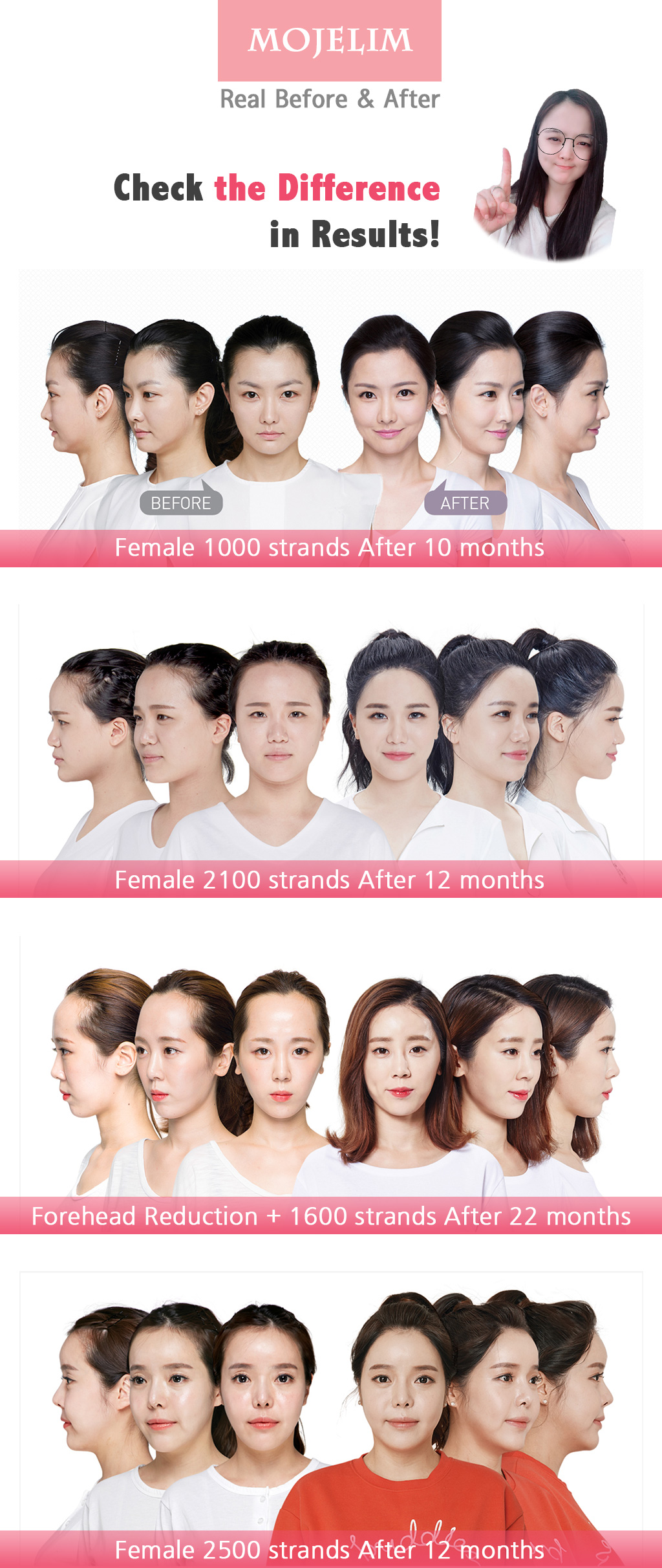 MOJELIM hair surgery x AllaboutMEI special offer / before and after photos of MOJELIM for females hairline / the lowest price in AllaboutMEI