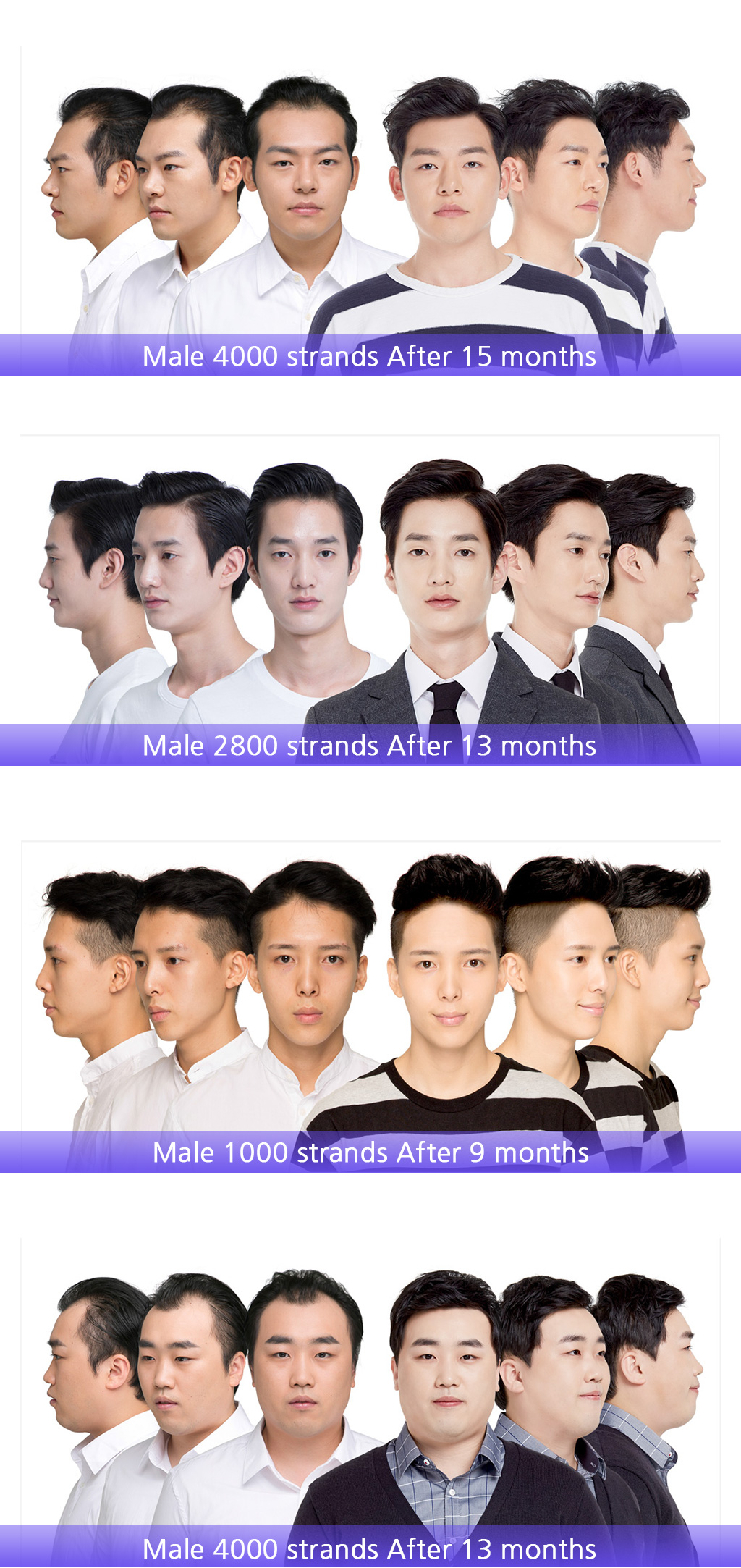 MOJELIM hair surgery x AllaboutMEI special offer / before and after photos of MOJELIM for male hair transplantation / the lowest price in AllaboutMEI