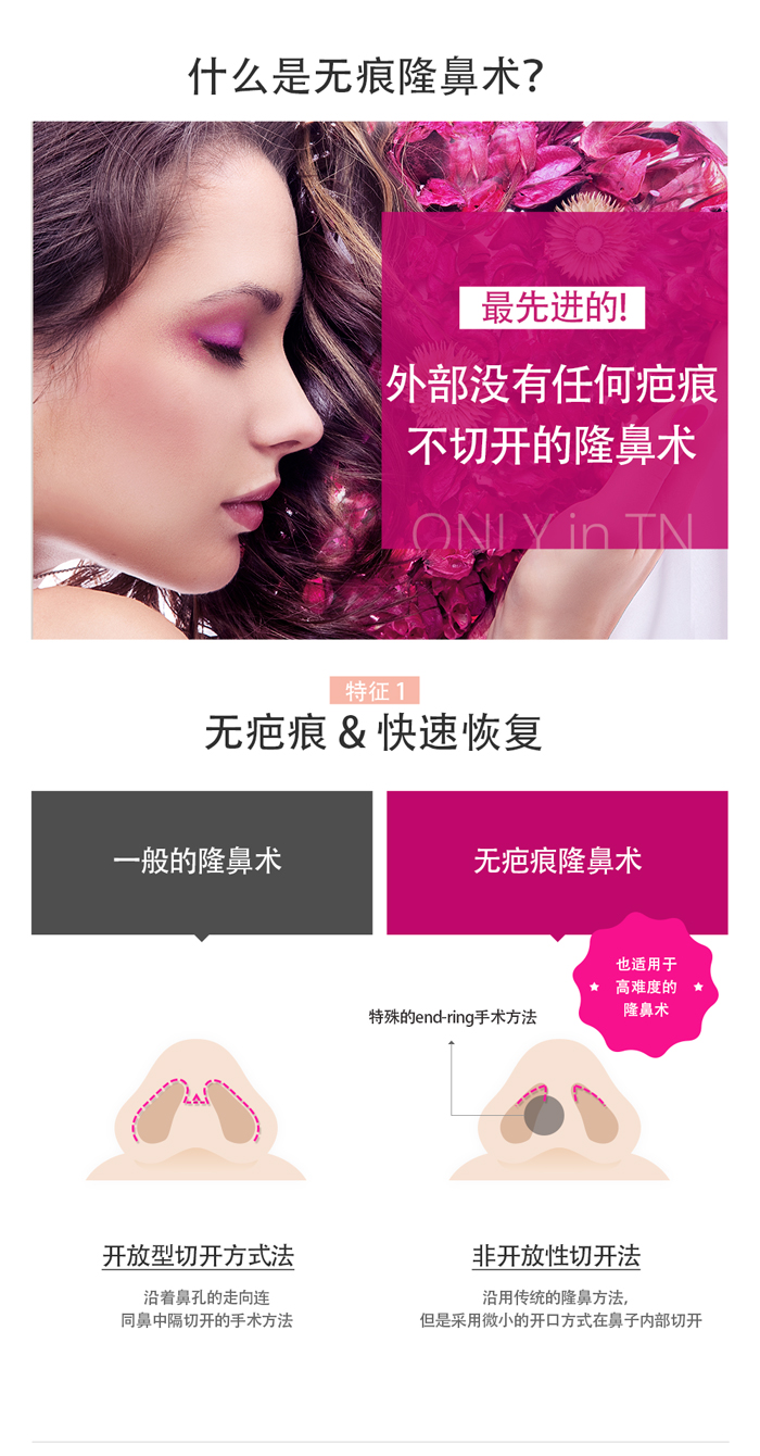 韩国TN整形外科 X AllaboutMEI 隆鼻术 特价活动 / no scar nose surgery in Korea with quick recovery