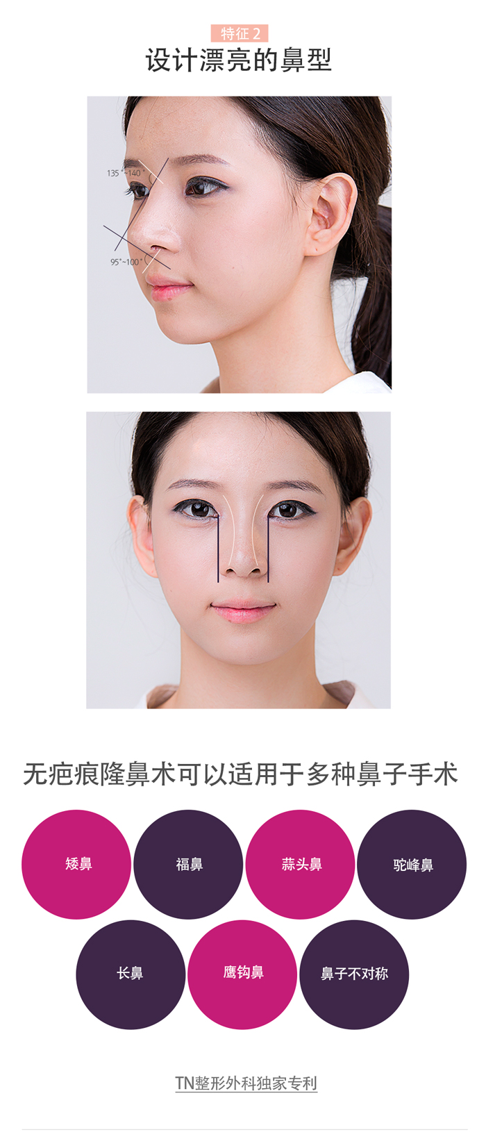 韩国TN整形外科 X AllaboutMEI 隆鼻术 特价活动 / beautiful and natural shape to create by no scar rhinoplasty