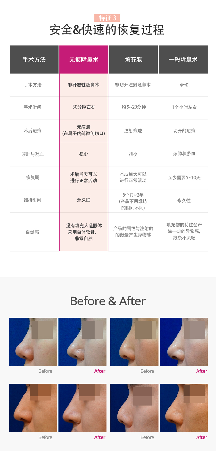 韩国TN整形外科 X AllaboutMEI 隆鼻术 特价活动 / before and after photos of TN's no scar nose surgery / the lowest price