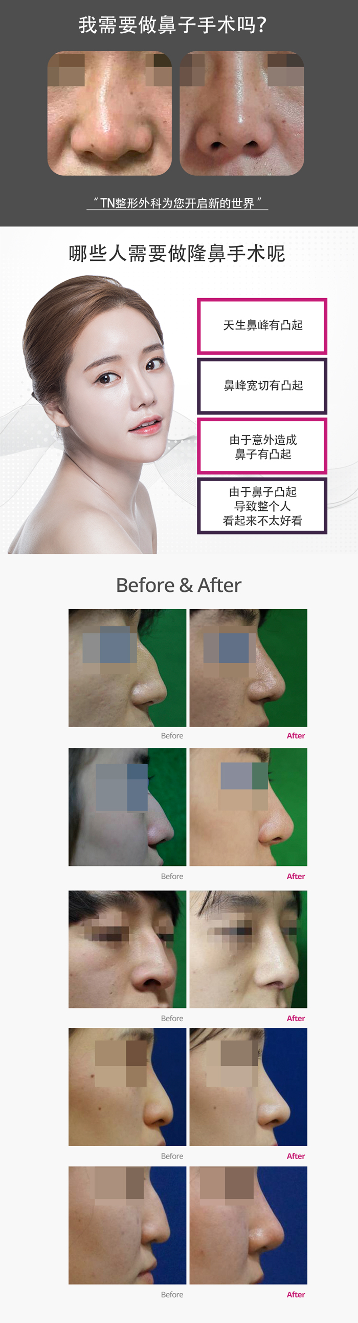 韩国TN整形外科 X AllaboutMEI 隆鼻术 特价活动 / hump nose surgery with the lowest price in All about MEI