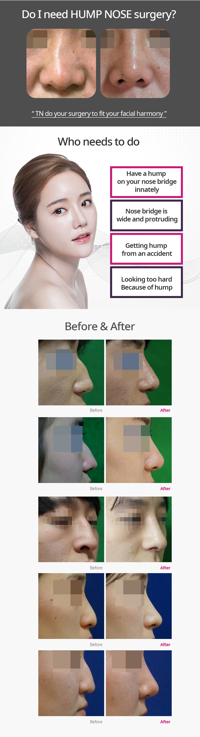TN x AllaboutMEI special offer / hump nose surgery with the lowest price in AllaboutMEI