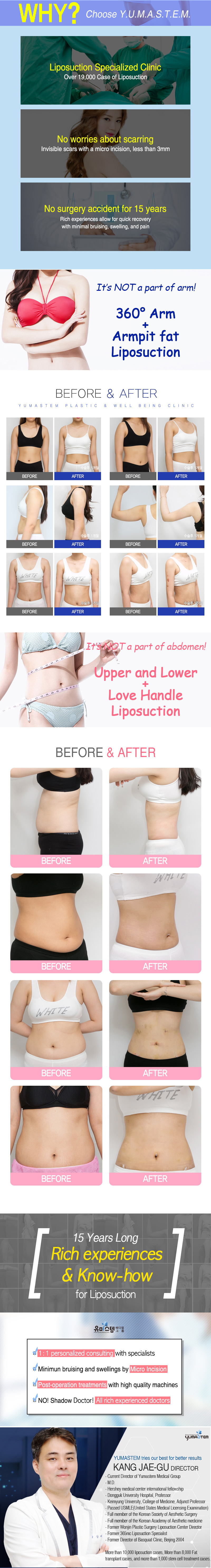 Before and after photos of YUMASTEM's patients. Dr.Kang's liposuction and fat grafting